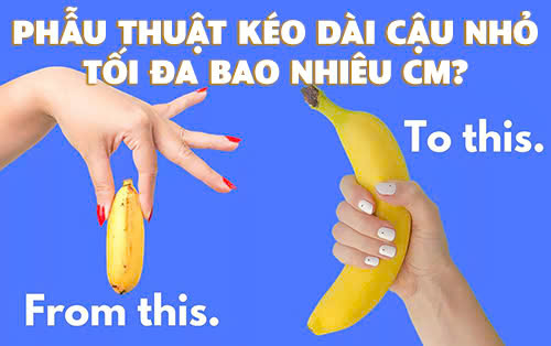 Phẫu thuật kéo dài cậu nhỏ tối đa bao nhiêu cm? Giải đáp từ y khoa